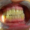 This is an all ceramic 5 unit (teeth) bridge. Can you tell where it is?