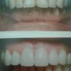 Porcelain veneers are an excellent choice for incisal edge fractures