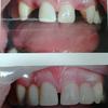 Bridgework greatly improves your smile in any circumstances