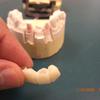 Our laboratory takes pride in fabricating all your dental crowns and bridges