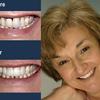 Replacing old bridges with metal margins can greatly improve your smile