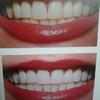Whitening systems help improve your smile to a natural white color...
