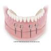 picture of how the implants look inside the lower denture
