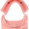 view of the mini implants in mandible model and the housings inside the lower denture